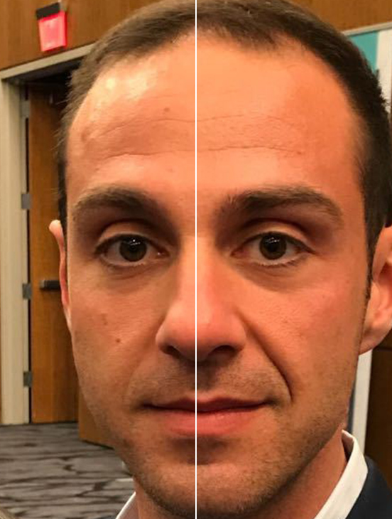 Forma RF Skin Tightening: Before and After Photos: Male, frontal view