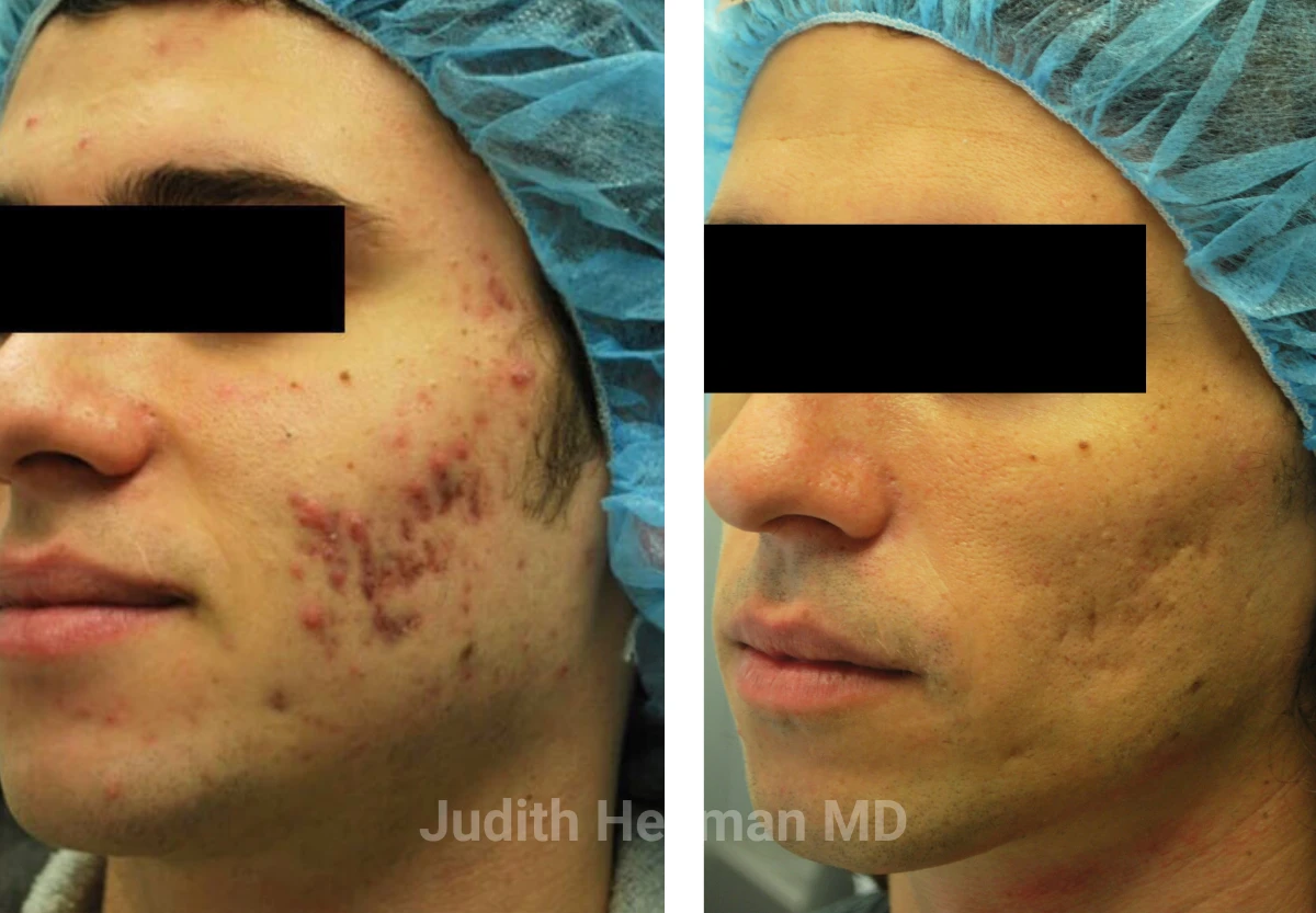 Male face, before and after Acne scars treatment, oblique right side view, patient 6