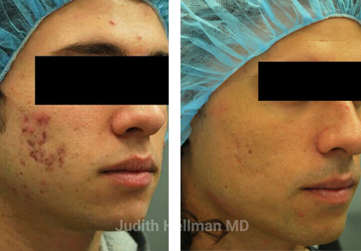 Male face, before and after Acne scars treatment, oblique right side view, patient 6