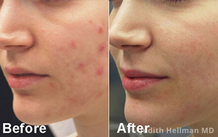 Woman's face, before and after Acne scars treatment, oblique left side view, patient 8