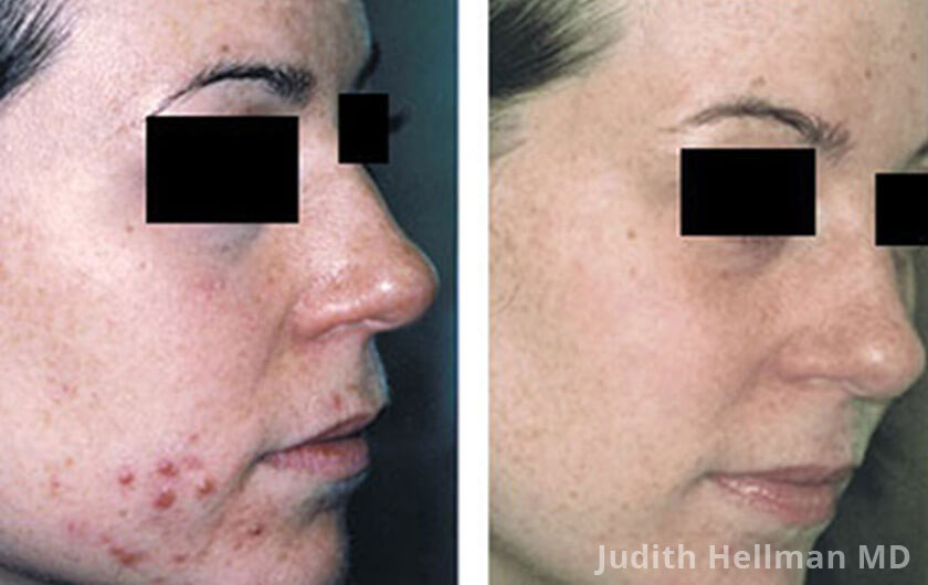 Young woman's face before and after acne treatment. Right cheek. Patient 9