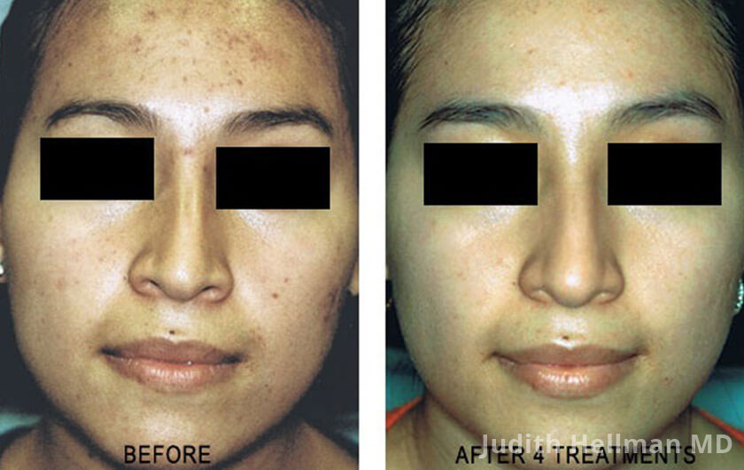 Young woman's face before and after acne treatment, forehead, front photo, patient 10