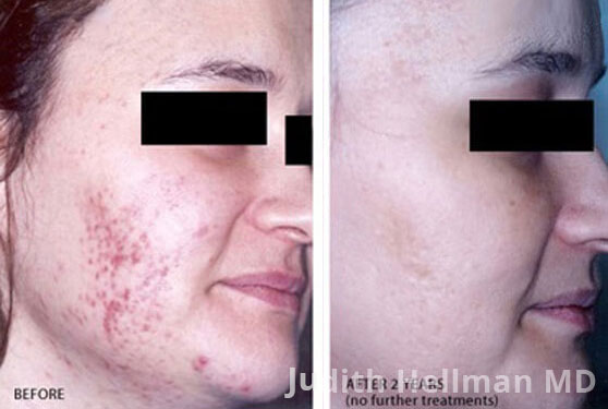 Woman's face, before and after Acne scars treatment, oblique right side view, patient 10