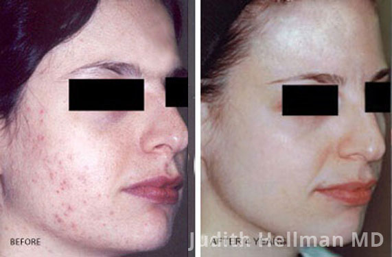 Woman's face, before and after Acne scars treatment, oblique right side view, patient 11