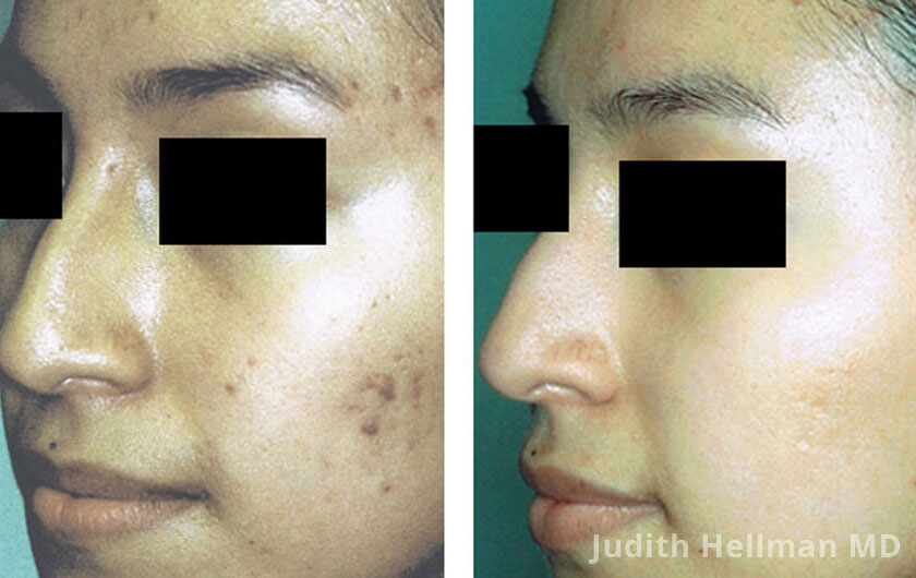 Woman's face, before and after Acne scars treatment, oblique left side view, patient 9