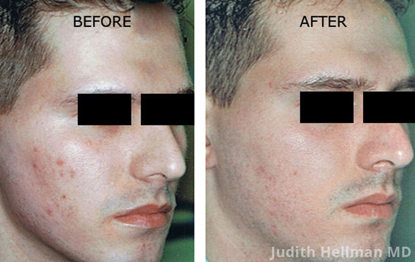 Male face, before and after Acne scars treatment, oblique right side view, patient 14
