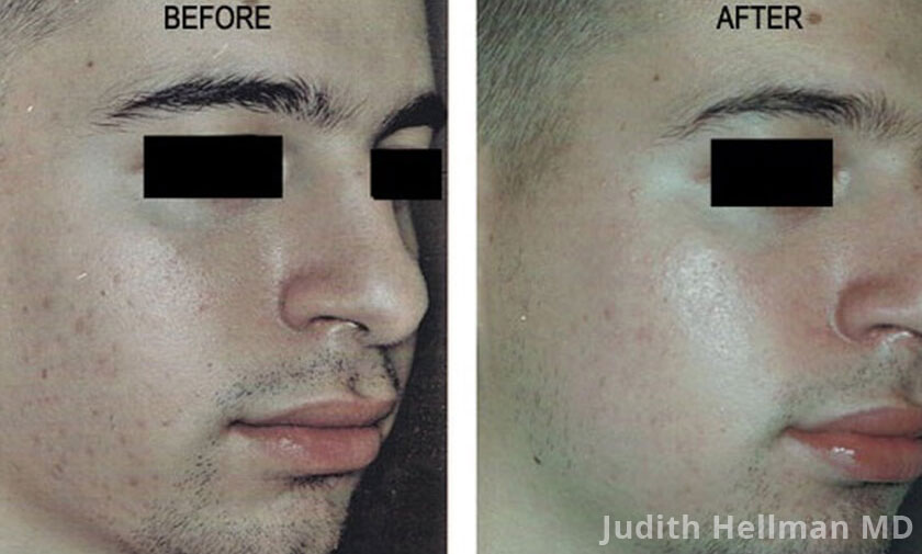 Male face, before and after Acne scars treatment, oblique right side view, patient 15