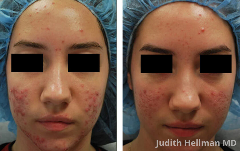 Young woman's face before and after acne treatment. Cheek, front photo. Patient 2