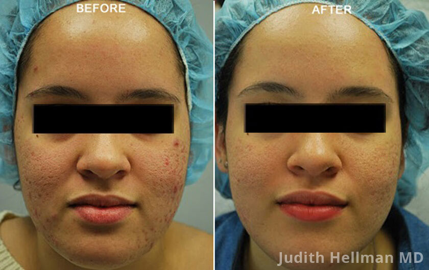 Young woman's face before and after acne treatment. Cheek, front photo. Patient 3