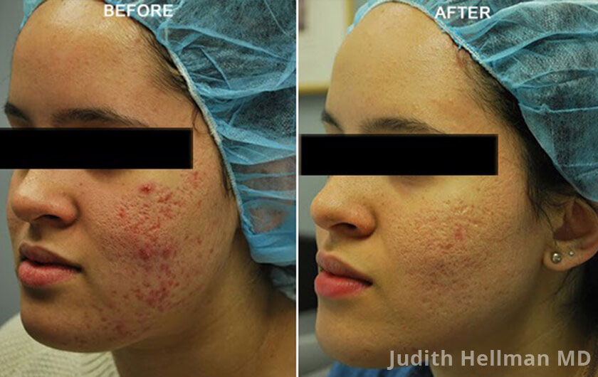 Woman's face, before and after Acne scars treatment, oblique left side view, patient 4