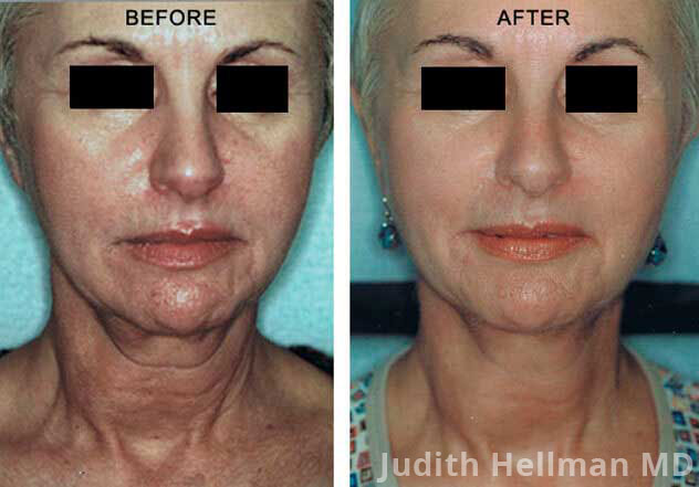 Affirm Multiplex - Before and After Treatment Photos: Female (frontal view)