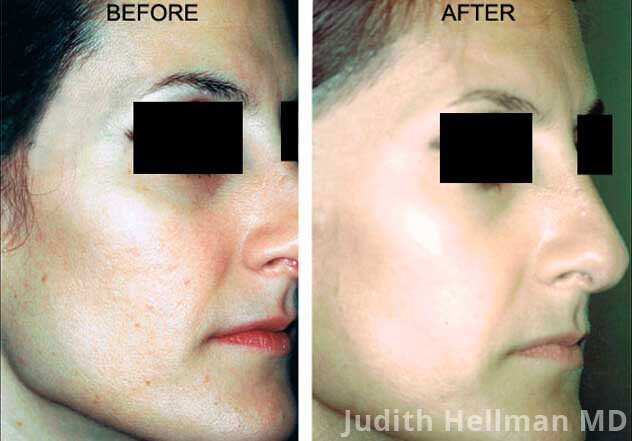 Affirm Multiplex - Before and After Treatment Photos: Woman (oblique view)