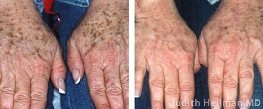 Fotofacial for aging hands