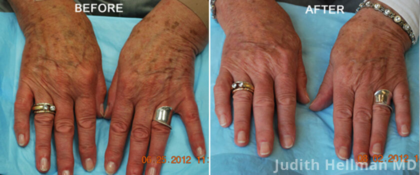 Fotofacial for aging hands