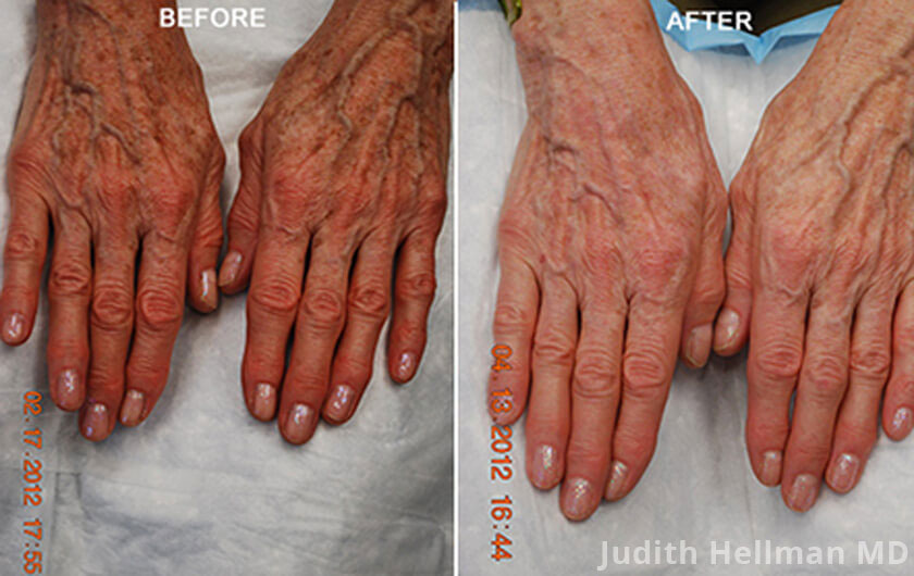 Fotofacial for aging hands