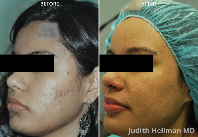 Woman's face, before and after Acne scars treatment, oblique left side view, patient 2