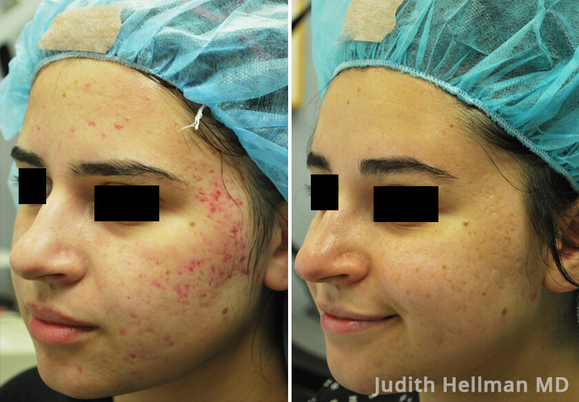 Young woman's face before and after acne treatment. Right cheek. Patient 5