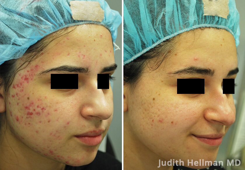 Young woman's face before and after acne treatment. Right cheek. Patient 5