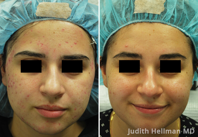 Young woman's face before and after acne treatment. Right cheek. Patient 5