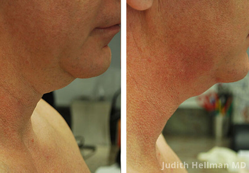 Male face, before and after double chin removal treatment. Face, neck, right side view - patient 1