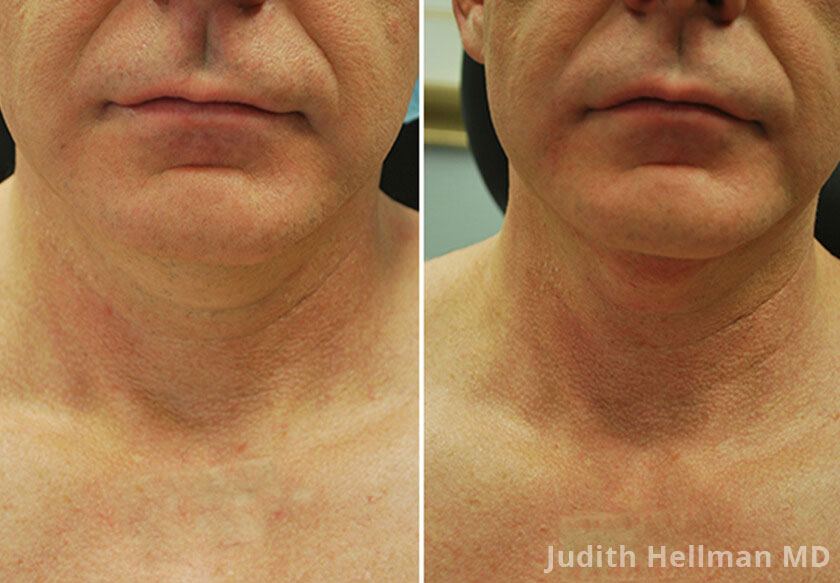 Male face, before and after double chin removal treatment. Face, neck, front view - patient 2