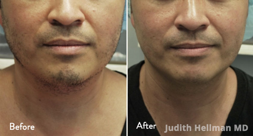 Male face, before and after double chin removal treatment, front view - patient 6
