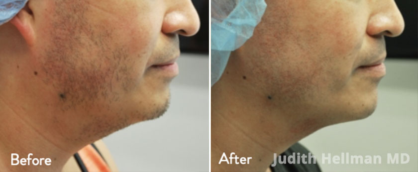 Male face, before and after double chin removal treatment, left side view - patient 7