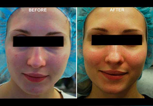 Forma RF Skin Tightening. Before and After Treatment Photos: Female patient, frontal view
