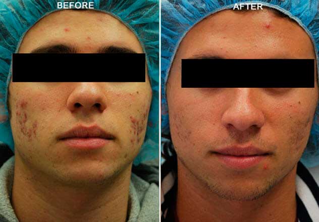 Forma RF Skin Tightening: Before & After Photos: Male face, face frontal view (pat. 2)