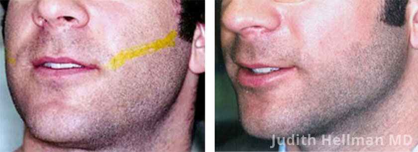 Laser Hair Removal: Before and After Photos - patient (tummy)