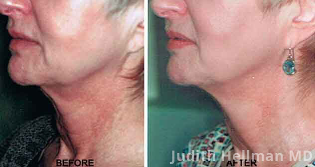 Non-surgical Neck Lift - Before and After Photos: Female (neck, left side view)