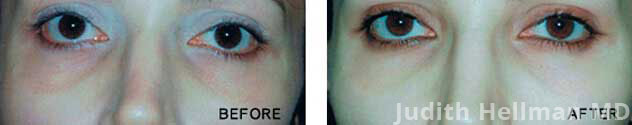 Woman's eyes, Before and After Non-Surgical Under Eye Bag Removal Treatment, front view