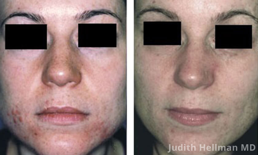 Woman's face, before and after 5 Acne scars treatments, front view, patient 16