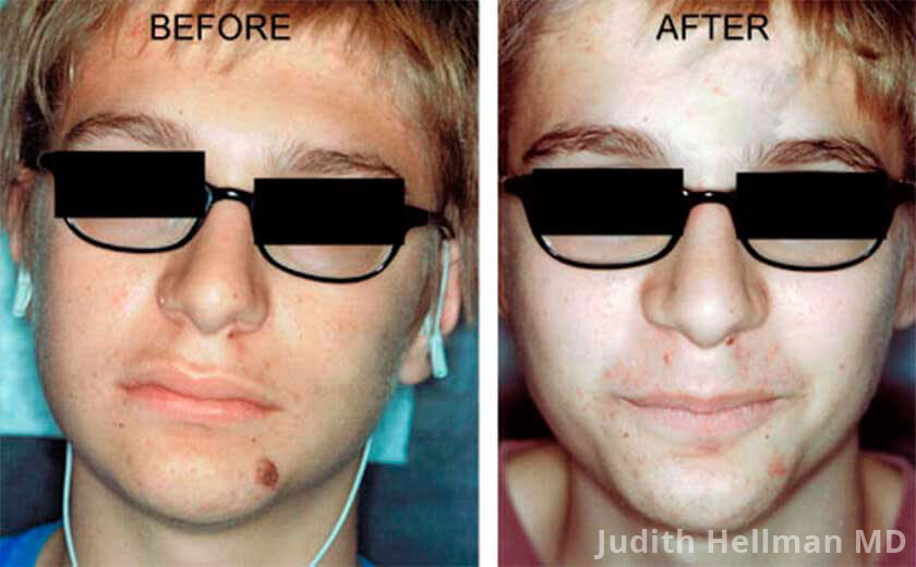 Skin Tags And Other Benign Moles - Before and After Photos - Patient 1