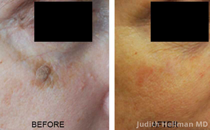 Skin Tags And Other Benign Moles - Before and After Photos - Patient 2