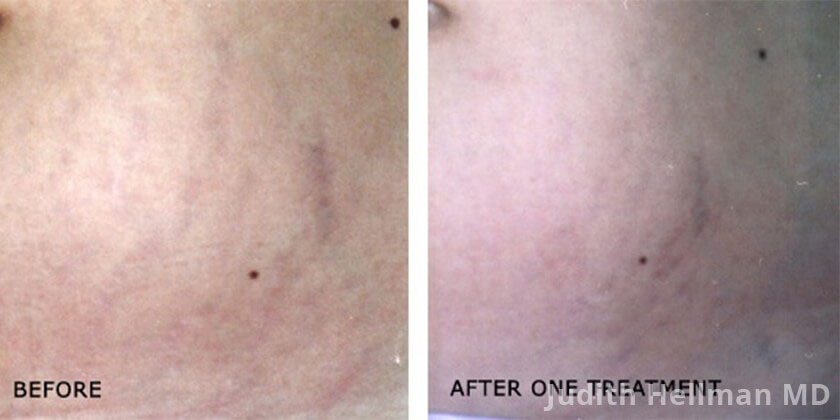 Female body, before and after stretch marks treatment. Abdomen