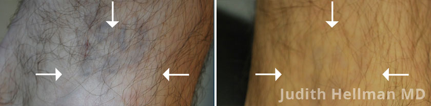 Tattoo Removal With The Naturalase Qs - Before and After photos - patient 1